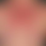 Dermatomyositis. Rot-violettes,&nbsp;wenig juckendes, flächiges. unscharf begrenztes&nbsp;Erythem...