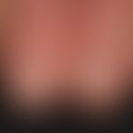 Dermatomyositis (Keining Zeichen): Flächige rote Plaques an den Endphalangen, periungual verstärk...