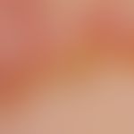 Dermatomyositis: Auflichtmikroskopie.&nbsp; Hyperkeratotische Nagelfalze. Pathologische vergrößer...