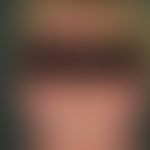 Dermatomyositis. Akut aufgetretenes heliotropes, sukkkulentes Exanthem; typische, ausgeprägte, sc...