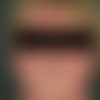 Dermatomyositis. Akut aufgetretenes heliotropes, sukkkulentes Exanthem; typische, ausgeprägte, sc...