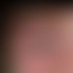 Dermatomyositis, juvenile: Symmetrische "fliederfarbene Eytheme". Krankheitsgefühl mit Abgeschlag...