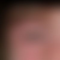 Dermatomyositis, juvenile: Symmetrische "fliederfarbene Eytheme". Krankheitsgefühl mit Abgeschlag...