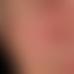 Dermatomyositis. Akut aufgetretenes heliotropes, sukkkulentes Exanthem; typische, ausgeprägte per...