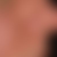 Adenoma sebaceum: diffuse distribution of skin-coloured, shiny papules and plaques. conspicuously...