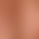 Acne cystica. In aknetypischer Verteilung neben zahlreichen (schwarzen) Komedonen und Brückenkome...