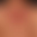 Acne fulminans: seit Monaten, bekannte Acne vulgaris; jetzt seit &nbsp;einigen Monaten schubweise...