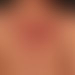 Acne fulminans: for months, known Acne vulgaris; now for several months intermittent febrile occu...
