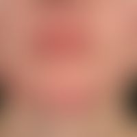 Acne papulopustulosa: multiple, entzündliche, follikuläre Papeln, Papulo-Pusteln, entzündliche Kn...