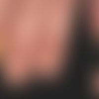Acrodermatitis continua suppurativa:&nbsp;typisches klinisches Bild. Seit 1 Jahr rezdivierender V...