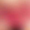 Bdnarsche Aphthen: großflächige, mit Fibrin belegte, sehr schmerzhafte flache Ulzera im Vestibulu...