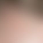 Alopezie postmenospausale fibrosierende:&nbsp; typische&nbsp;Einzelhaare (lonely hairs); &nbsp;pr...