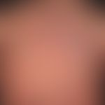 Alopezie postmenopausale, fibrosierende, gleichmäßiges&nbsp;Zurücktreten der frontalen&nbsp;und t...