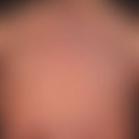 alopecia postmenopausal, fibrosing, uniform receding of the frontal and temporal hairline. encirc...