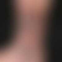 Angiokeratoma circumscriptum: Vaskuläre (venöse) Malformation der Haut (und Subkutis) mit umschri...