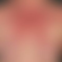 Dermatomyositis. Acutely occurring heliotropic, succulent exanthema. At the same time general fat...