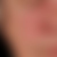 Dermatomyositis. acutely occurring heliotropic, succulent purple exanthema; typical, pronounced, ...