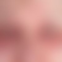 Dermatomyositis: Acute bilateral lid edema with blurred symmetrical eythema, general fatigue, mus...