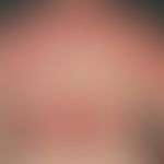 Dermatomyositis; acutely occurring, succulent exanthema, massive itching with scratching effects;...