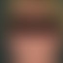 Dermatomyositis. Akut aufgetretenes heliotropes, sukkkulentes Exanthem; typische, ausgeprägte, sc...