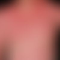 Dermatitis solaris: severe acute, sometimes oozing dermatitis solaris in a 35-year-old man who ha...