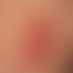 Dermatitis solaris: Hier aus Testzwecken ur Bestimmung der Lichtempfindlkichkeit (Lichttreppe)
