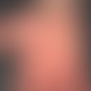 Dyshidrosis lamellosa sicca. 42-jähriger Patient mit schubweise rezidivierenden, feinsten (häufig...