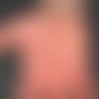 Dyshidrosis lamellosa sicca. 42-jähriger Patient mit schubweise rezidivierenden, feinsten (häufig...