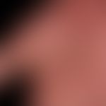 Dyshidrotische Dermatitis: beide Handflächen betreffende, chronisch rezidivierende, teils vesikul...