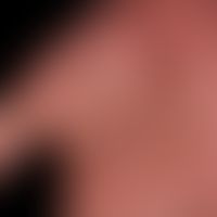 Dyshidrotische Dermatitis: beide Handflächen betreffende, chronisch rezidivierende, teils vesikul...