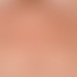 Dyskeratosis follicularis. Darstellung von multiplen, chronisch stationären, submammär und am Obe...