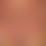 Dyskeratosis follicularis. Chronische auch die Rima ani betreffende (s. Detailaufnahme), intertri...