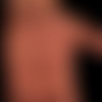 Psoriasis palmaris et plantaris (pustulöser Typ): Flächiges Erythem der gesamten Handfläche. zum ...