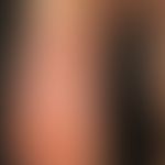 Psoriasis palmaris et plantaris (plaque-type chronic inpatient plaquepsoriasis of the sole of the...