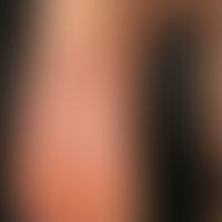 Psoriasis palmaris et plantaris (plaque-type chronic inpatient plaquepsoriasis of the sole of the...