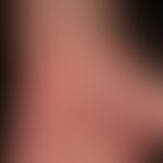 Psoriasis palmaris et plantaris (plaque type): flat palmar erythema; striated keratotic plaques t...