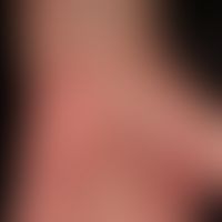 Psoriasis palmaris et plantaris (Plaquetyp): flächiges Palmarerythem; streifenförmgie keratotisch...