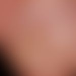 Glomus tumor. solitary, painful defect formation of the nail, accompanied by stabbing pain that o...