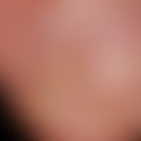 Glomus tumor. solitary, painful defect formation of the nail, accompanied by stabbing pain that o...