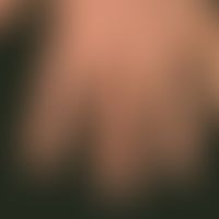 Granuloma anulare subcutaneum. multiple chronically stationary, firm, symptomless, subcutaneously...