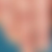 Granuloma anulare subcutaneous type: Numerous painless, deep cutaneous, skin-coloured nodules on ...