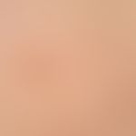 Café-au-lait stains: in neurofibromatosis type I. 2 medium brown homogeneously coloured light bro...