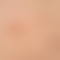 Café-au-lait stains: in neurofibromatosis type I. 2 medium brown homogeneously coloured light bro...