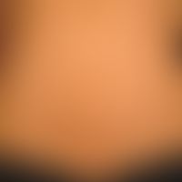 Café-au-lait spots: in discrete neurofibromatosis type I. Several medium brown spots in the area ...
