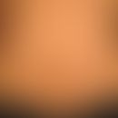 Neurofibromatose periphere:&nbsp;Café au lait Flecken bei Neurofibromatose Typ I.
