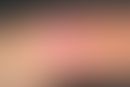 Calcinosis (cutis) dystrophica&nbsp;bei progressiver systemischer Sklerodermie. Seit mehreren Mon...