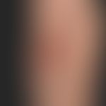 Calcinosis dystrophica of unknown aetiology; circumscribed, non-painful, plate-like hardenings wi...