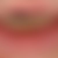 Cheilitis actinica chronica: Scaly flat leukoplakia with rhagade formation.
