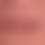 Cheilitis actinica chronica: two-dimensional veil-like leukoplakia of the red of the lips; lentig...