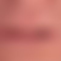 Cheilitis actinica chronica: flächige schleierartige Leukoplakie des Lippenrots. Rhagadenbildung....